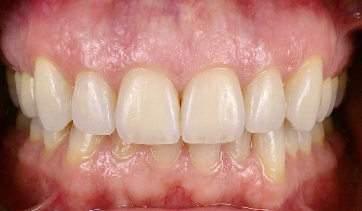 Denti anteriori più allineati e simmetrici dopo il trattamento