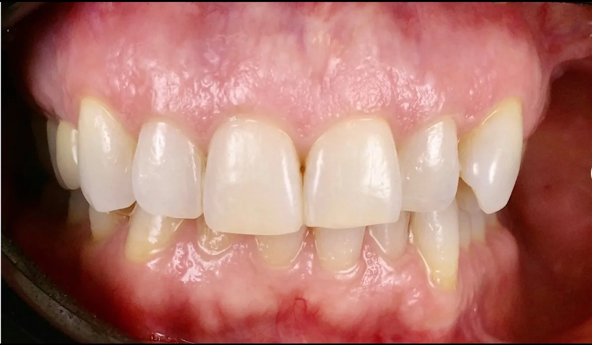 Denti anteriori prima del trattamento