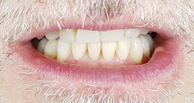 Arcata dentale completamente usurata dal bruxismo, prima della ricostruzione