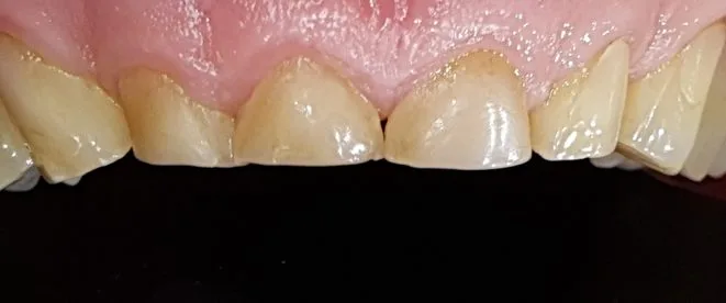 Margini dei denti anteriori appiattiti dal bruxismo