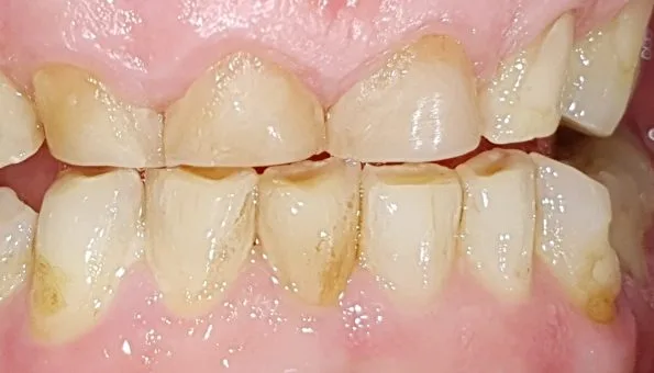 Usura avanzata dei denti causata dal bruxismo