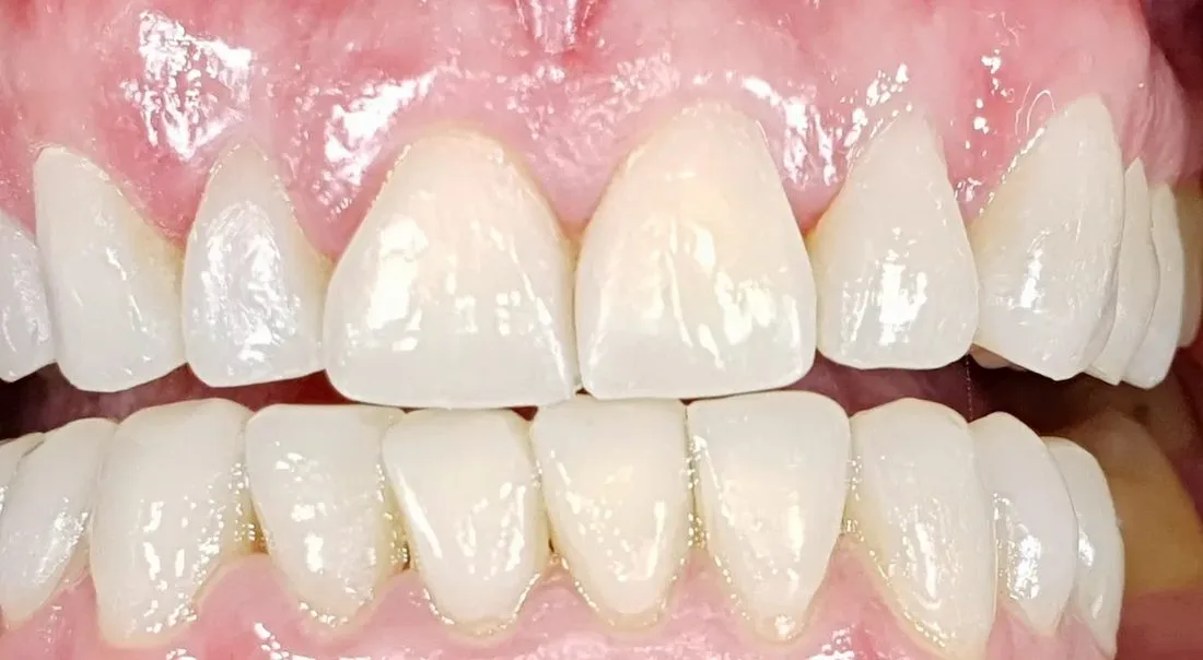 Denti ricostruiti con la Flowable Injection Technique
