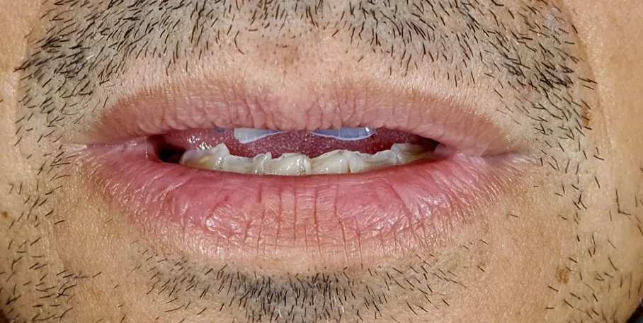 Denti usurati dal bruxismo prima della FIT