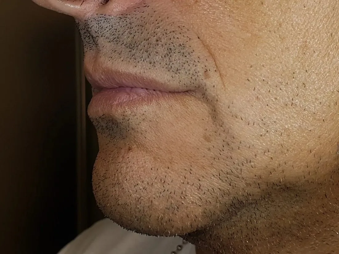 Profilo del labbro sostenuto dopo la FIT