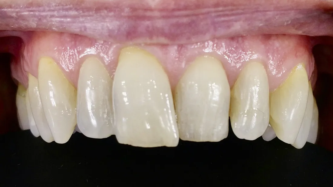 Denti prima del mock-up per faccette