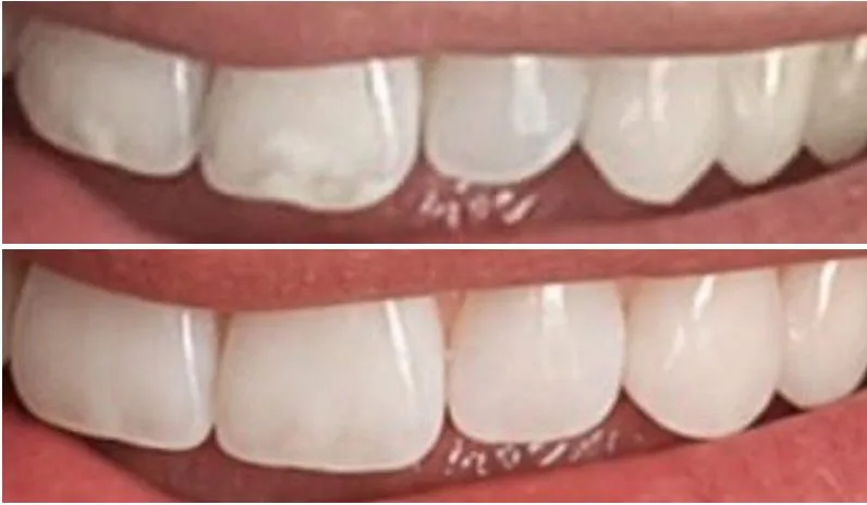 Confronto tra un dente reale e la sua simulazione generata dall'Intelligenza Artificiale