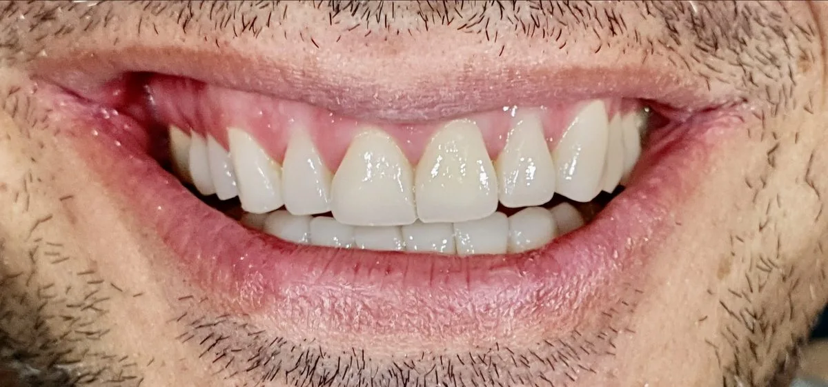 Caso reale dopo la ricostruzione con Flowable Injection Technique