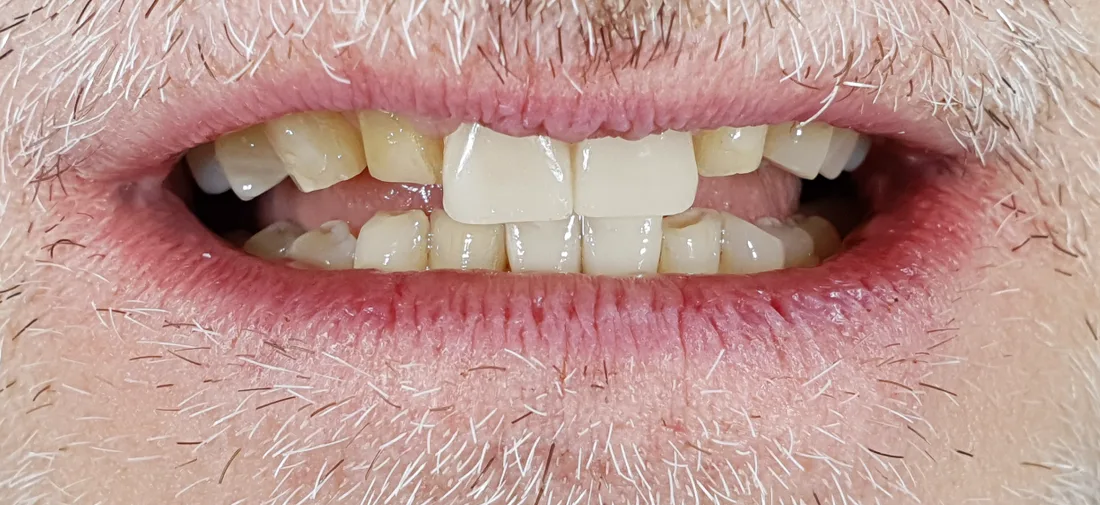 Mock-up sui due incisivi centrali a confronto con i denti adiacenti consumati, caso di full-arch