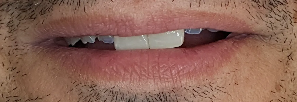 Contrasto tra il mock-up e un dente adiacente danneggiato