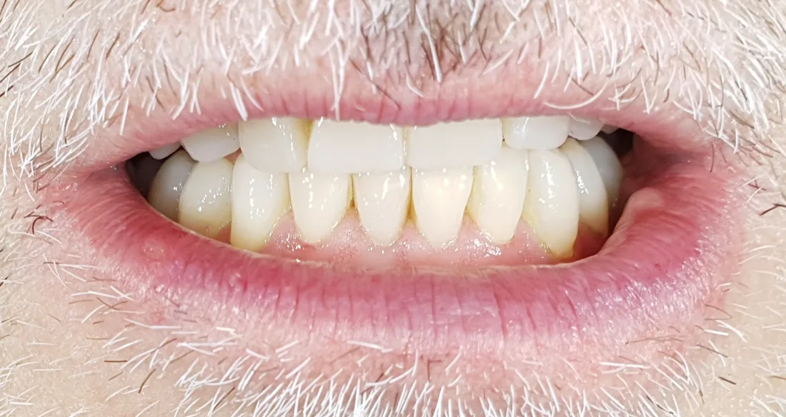 Denti anteriori ricostruiti con la Flow Injection Technique