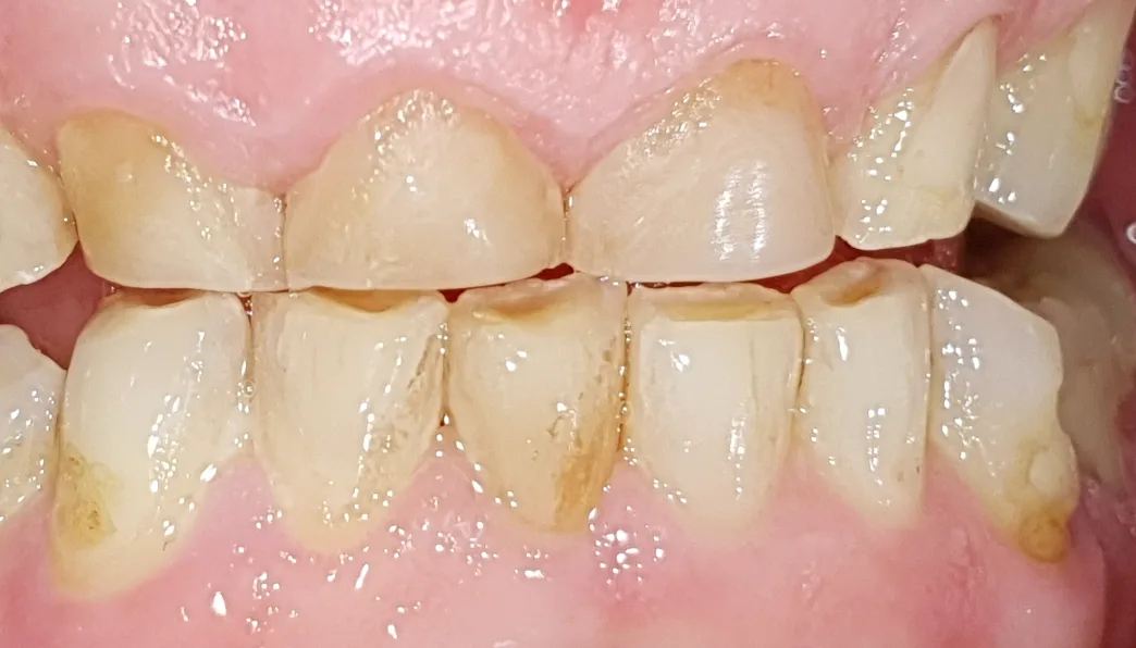 Denti anteriori con otturazioni usurate e scolorite, prima della ricostruzione