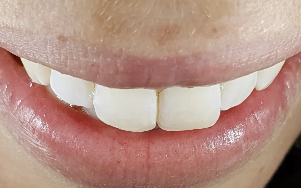 Lo stesso sorriso dopo il bonding immediato, con i margini degli incisivi ricostruiti