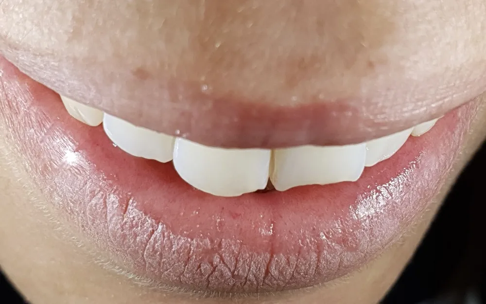 Sorriso di una paziente di vent'anni con gli incisivi superiori scheggiati dopo un trauma