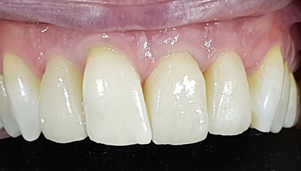 Gli stessi denti dopo l'applicazione delle faccette in ceramica di disilicato