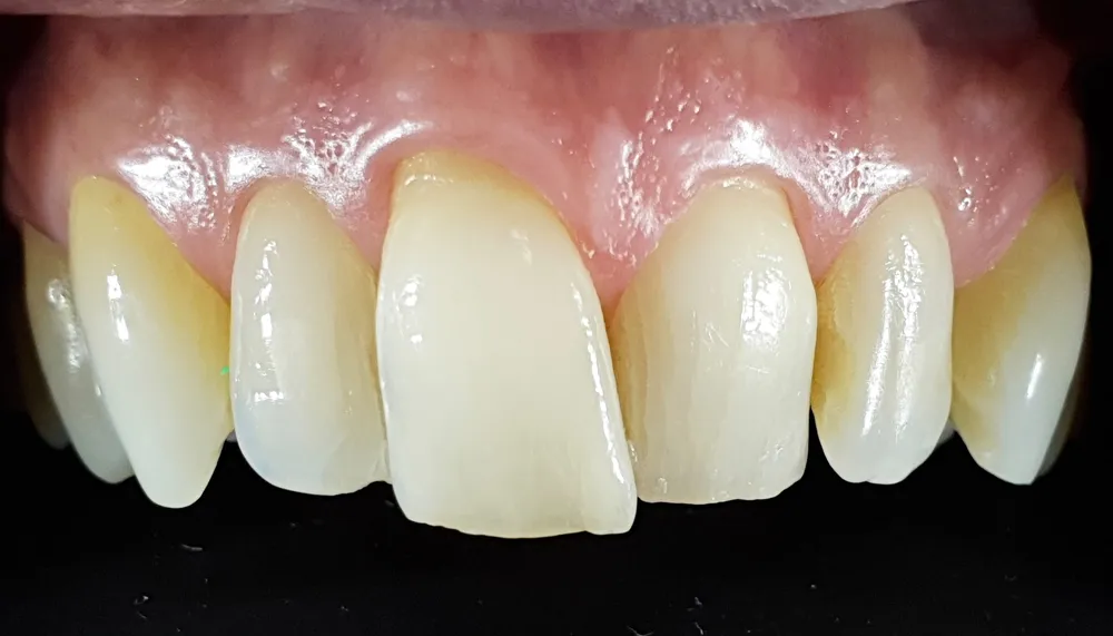 Incisivi superiori con forma e allineamento irregolari prima delle faccette in ceramica