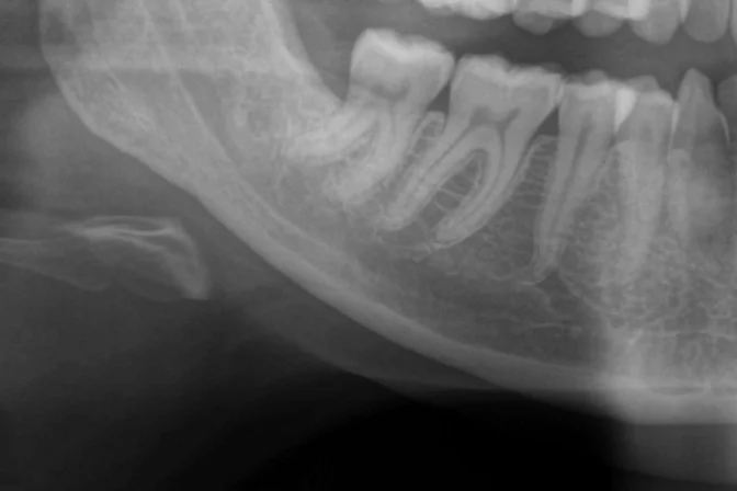 Radiografia panoramica a sei mesi dall'intervento, con l'osso riformato