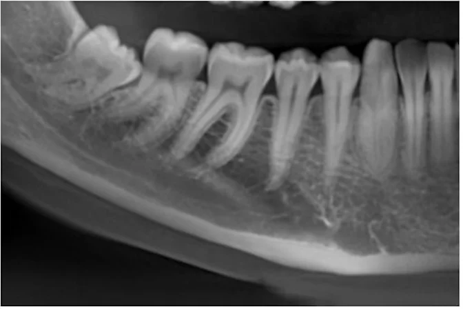Radiografia panoramica con il dente del giudizio inferiore destro incluso, prima dell'intervento