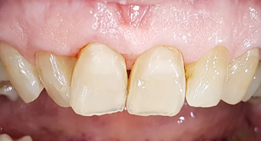 La stessa gengiva dopo l'asportazione, guarita e senza difetti estetici