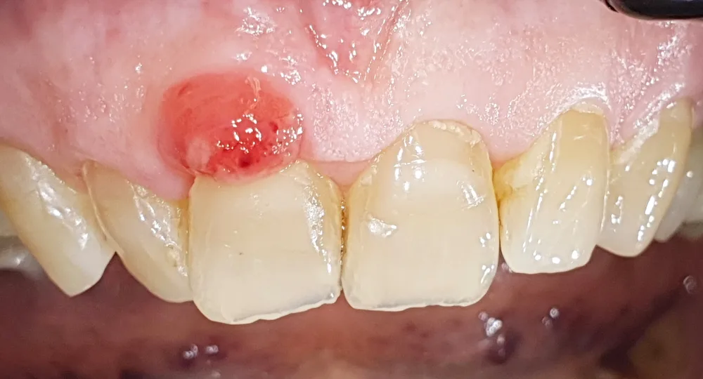 Epulide sulla gengiva sopra l'incisivo centrale superiore