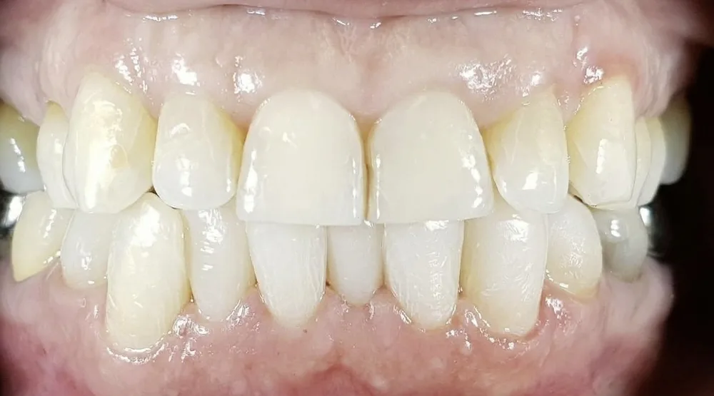 Gli stessi denti dopo la FIT sul gruppo inferiore, da premolare a premolare, con le altezze ripristinate