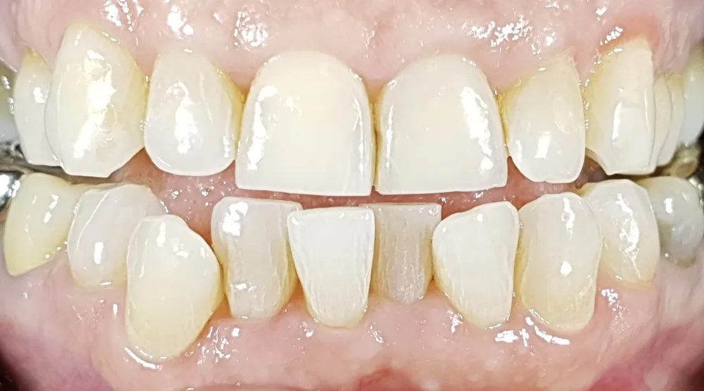 Denti inferiori affollati, con il canino destro in posizione che crea uno spazio scuro tra i denti