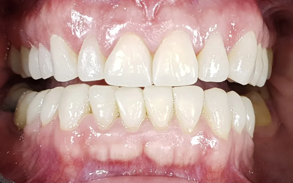 Le stesse arcate ricostruite con la FIT, a denti stretti
