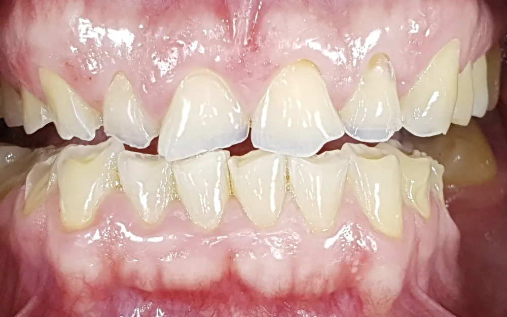 Denti anteriori superiori e inferiori molto consumati e scheggiati, a denti stretti