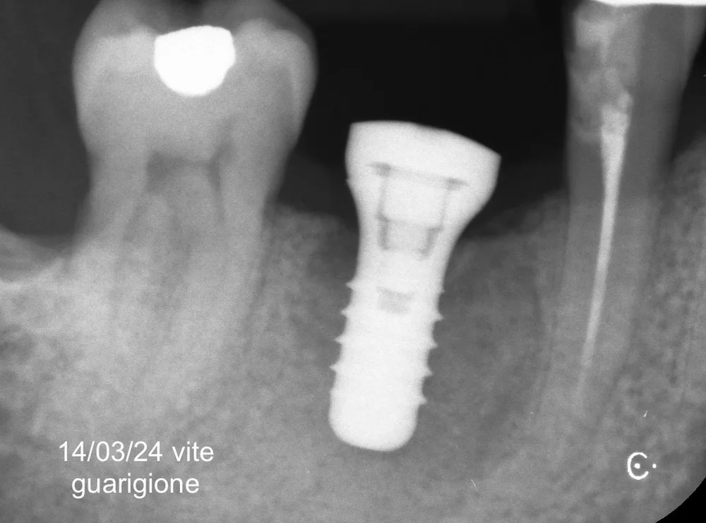 Radiografia dell'impianto in sede 46