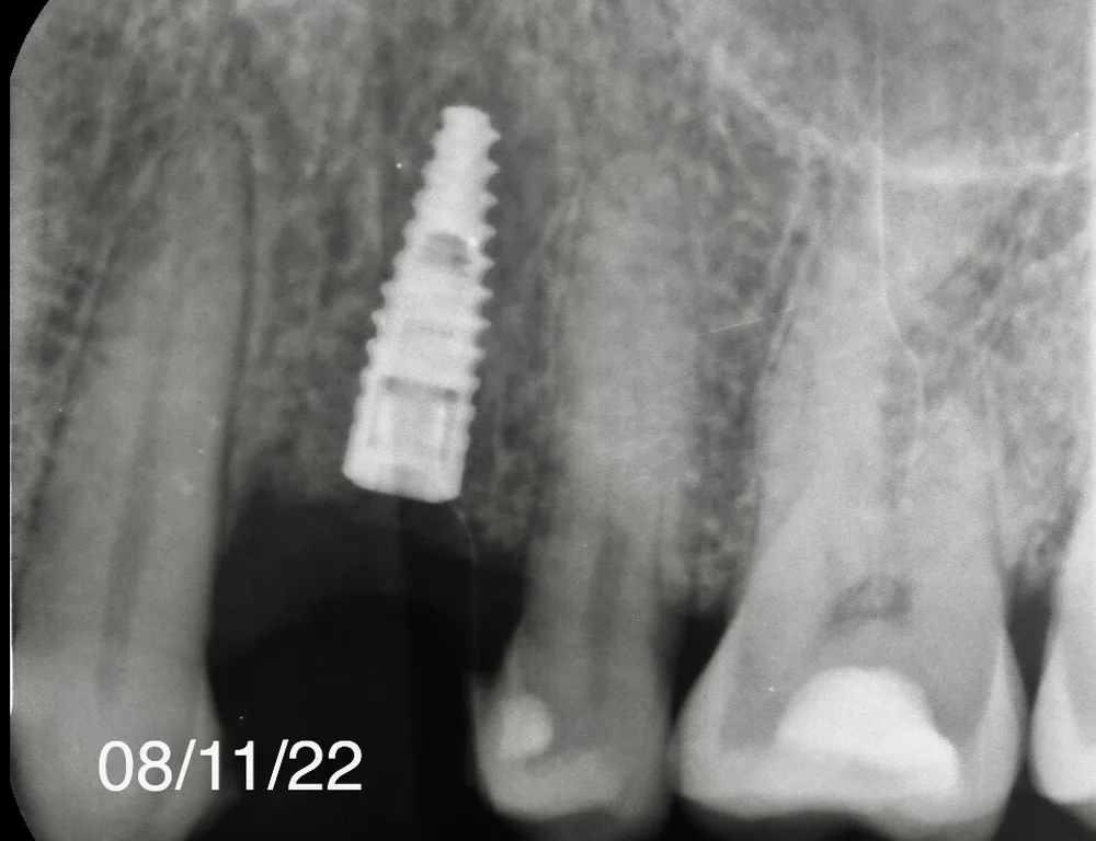 Radiografia dell'impianto inserito al posto dei residui radicolari