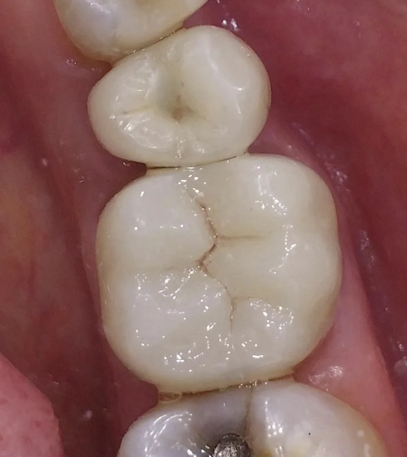 Corona sull'impianto in sede 35 e corona in zirconia sul dente 36, separate tra loro