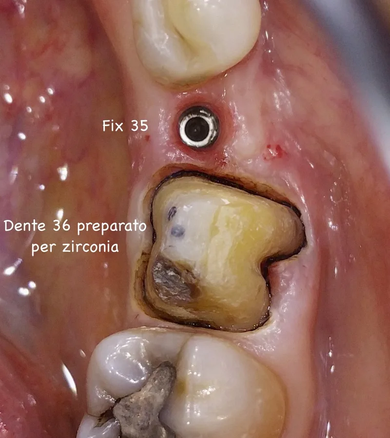 Impianto in sede 35 e dente 36 preparato per una corona in zirconia