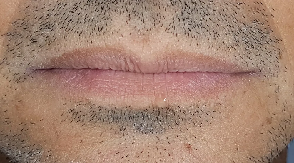 Labbra a bocca chiusa viste di fronte prima della ricostruzione, con la linea delle labbra che piega verso il basso