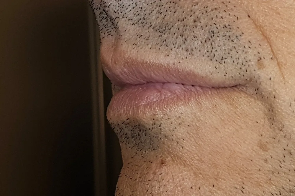 Profilo delle labbra a bocca chiusa dopo la ricostruzione, con il labbro più pieno nella parte anteriore