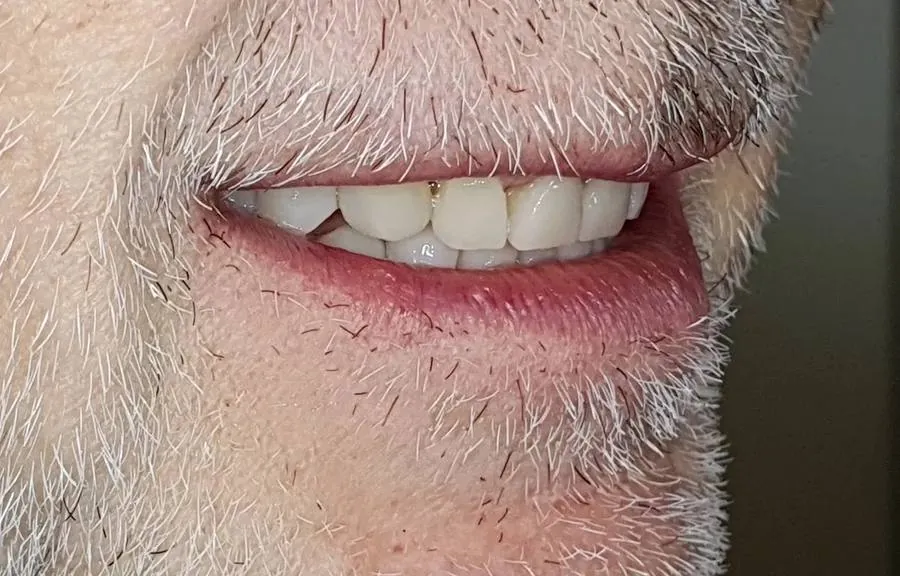 dopo