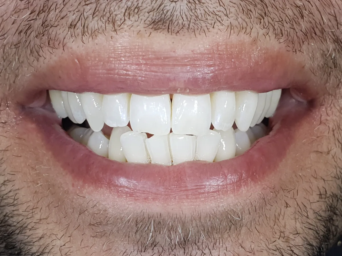 dopo