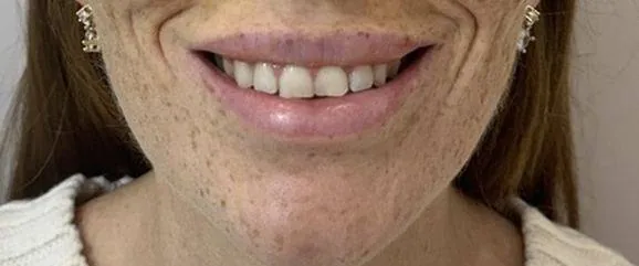Gummy Smile dopo