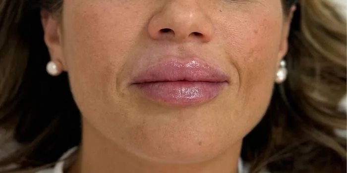 Filler labbra dopo